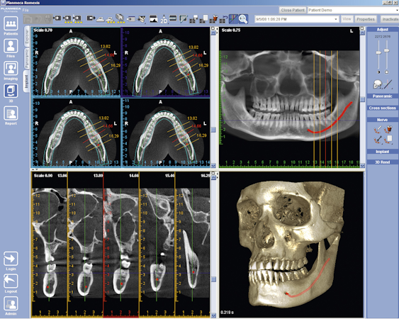 3D implant viewer 2