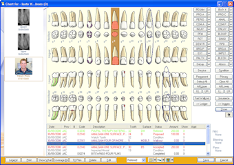 eaglesoft software chart dental
