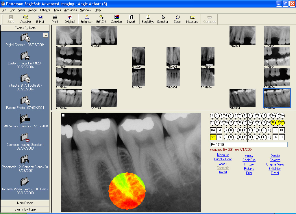 Patterson Eaglesoft Dental Charting