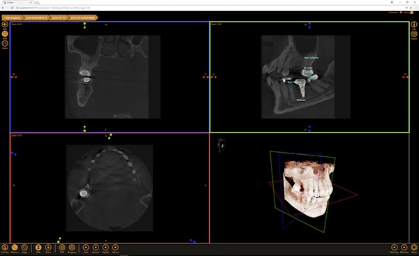 XVWeb 3D module for CBCT